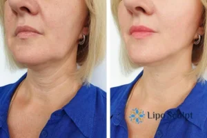 Double chin before and after Hi-Fu treatment 4 Book your double chin treatment Suffolk today! We are here to help!