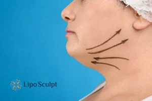 Double chin before and after Hi-Fu treatment 3 Boost your confidence with a Double chin treatment Suffolk