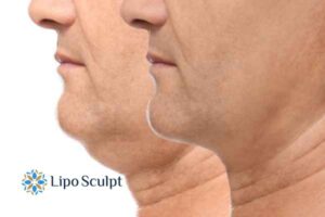 Double chin before and after Hi-Fu treatment 2 Double chin treatment Suffolk from Lipo Sculpt - feel more confident today!
