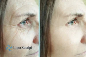 How to Fight Aging Symptoms 2 Do you want to Fight Aging Symptoms Suffolk? Contact Lipo Sculpt today!