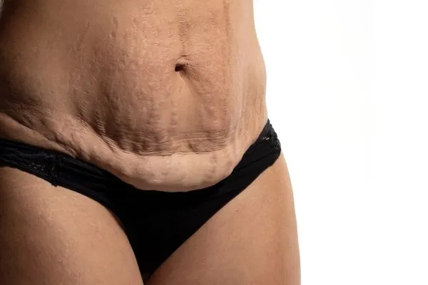 Lost the Weight but Not the Loose Skin? 1 image of womans stomach after weight loss showing loose skin Suffolk